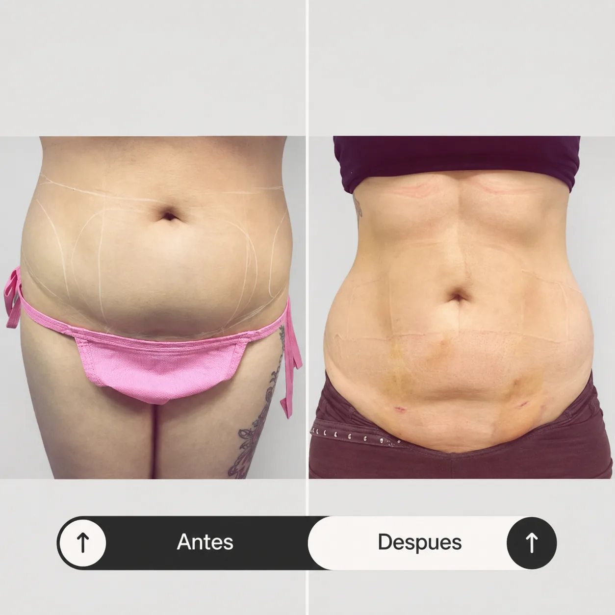 MELA (Mini Extracción Lipídica de Grasa Abdominal)